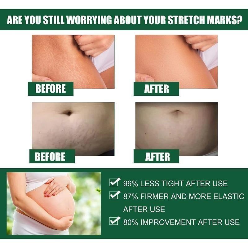 Stretch Mark Cream - Combo Offer - Pack of 2