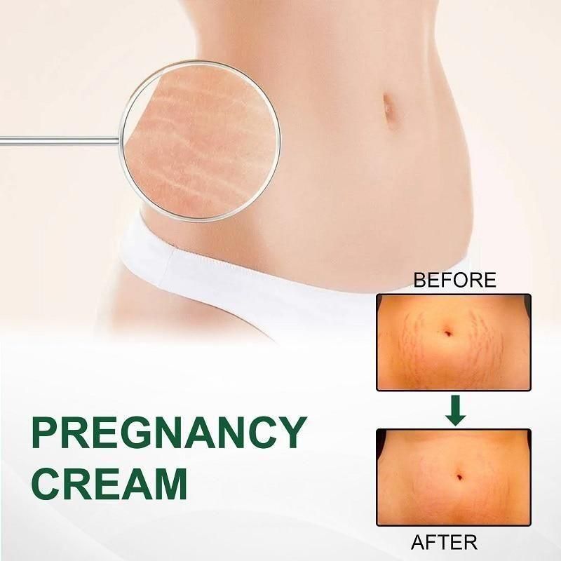 Stretch Mark Cream - Combo Offer - Pack of 2